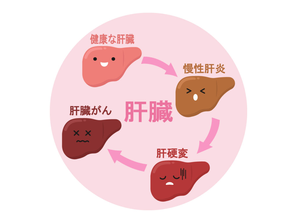 健康な肝臓から慢性肝炎、肝硬変、