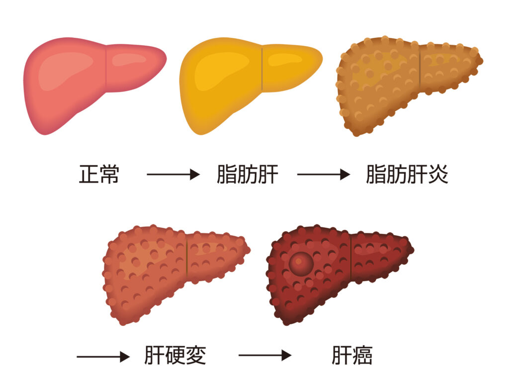 脂肪肝の病態